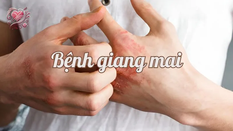 Bệnh giang mai - Những hiểu lầm phổ biến và sự thật