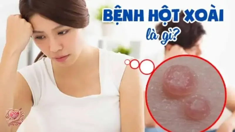 Bệnh hột xoài là gì? Dấu hiệu nhận biết và cách phòng ngừa