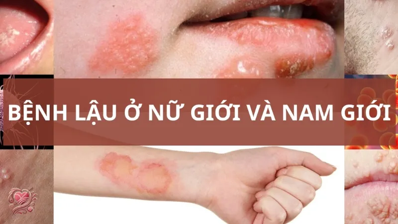Bệnh lậu cầu - Cẩm nang đầy đủ về bệnh xã hội nguy hiểm này