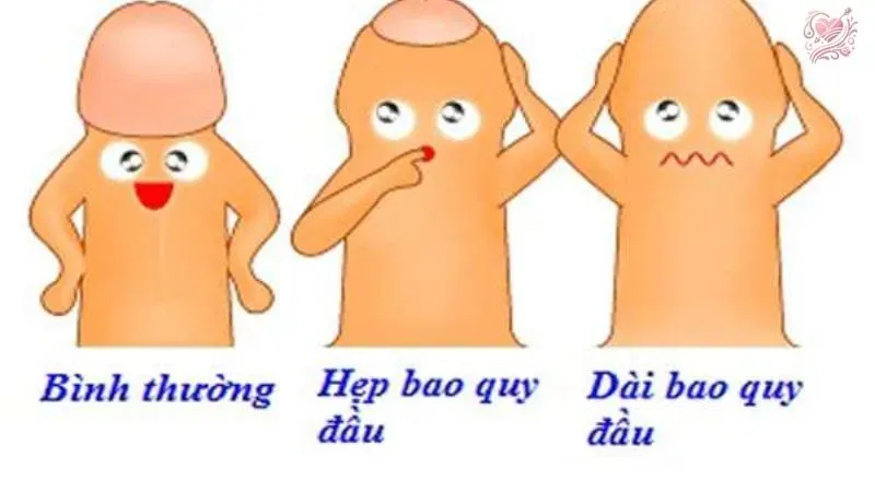 Hẹp bao quy đầu là gì? Nguyên nhân và cách điều trị?