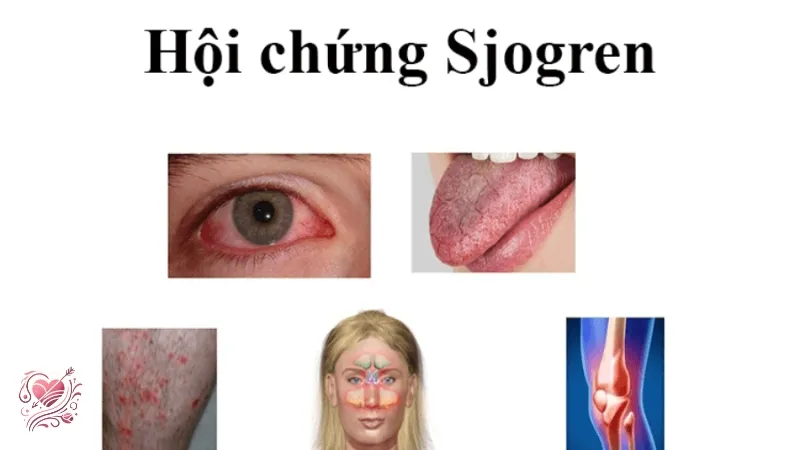 Hội chứng Sjogren ảnh hưởng thế nào đến sức khỏe toàn diện?