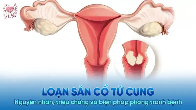 Cách nhận biết loạn sản cổ tử cung và các biện pháp điều trị