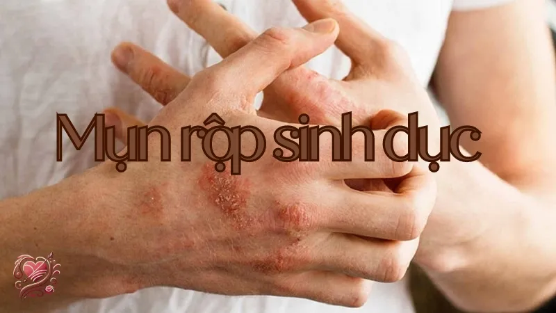 Mụn rộp sinh dục là gì? Tất cả những điều bạn cần biết