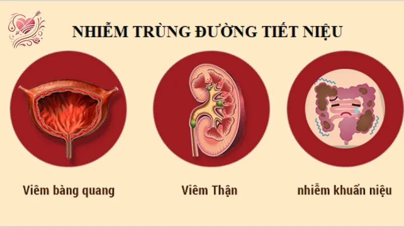 Giải đáp mọi thắc mắc về nhiễm trùng đường tiết niệu