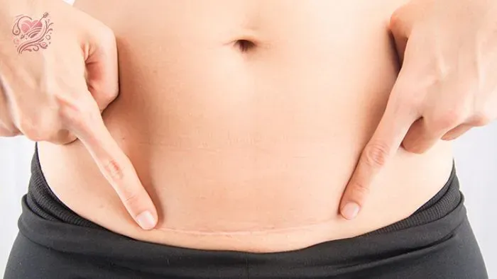 Quan hệ sau sinh mổ 1 tháng có thai không?