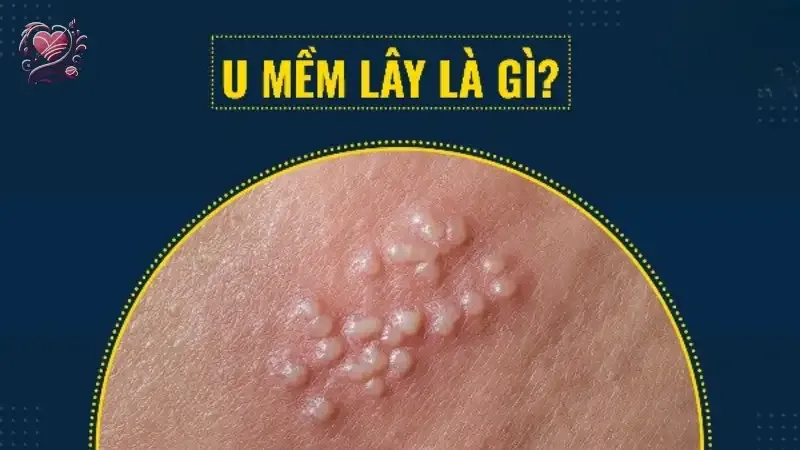 U mềm lây có nguy hiểm không? Những điều bạn cần biết