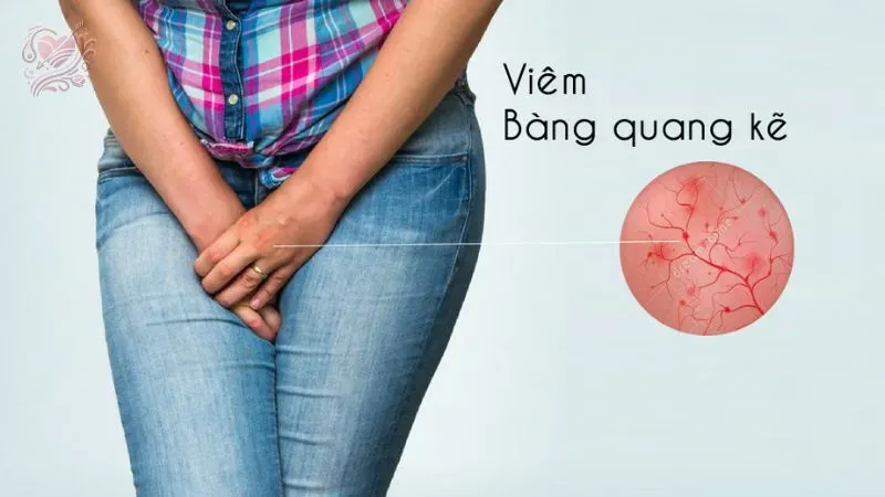 Viêm bàng quang kẽ nguyên nhân, triệu chứng và cách điều trị