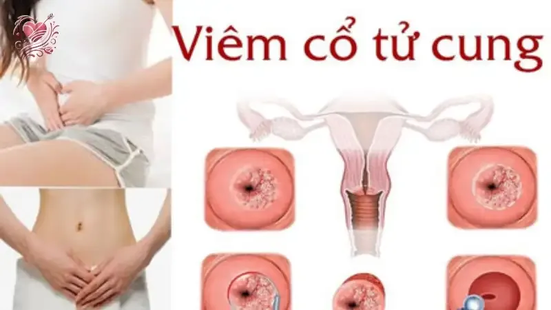 Các phương pháp điều trị viêm cổ tử cung hiệu quả hiện nay