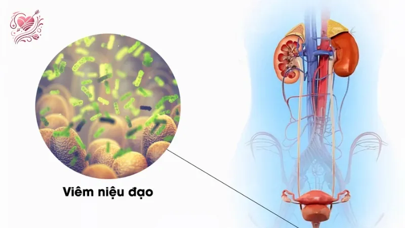 Viêm niệu đạo do lậu là gì? Dấu hiệu và phương pháp điều trị