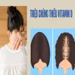 Dấu hiệu thiếu vitamin D và cách bổ sung hiệu quả cho cơ thể
