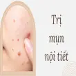 Trị mụn nội tiết dứt điểm hiệu quả chỉ sau 30 ngày