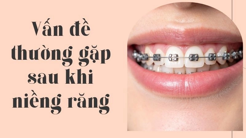 Giai đoạn làm quen với khí cụ và dây cung