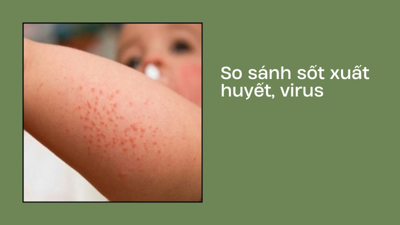 Cách phân biệt sốt xuất huyết và sốt virus