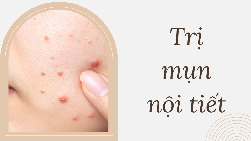 Dấu hiệu nhận biết mụn nội tiết đang 