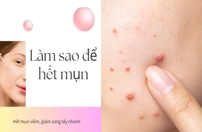 Làm sao để hết mụn viêm, giảm sưng tấy nhanh chóng nhất