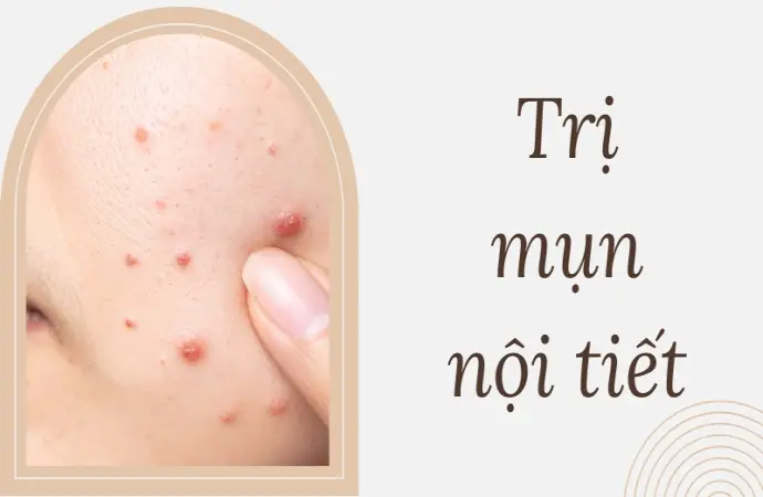 Trị mụn nội tiết dứt điểm hiệu quả chỉ sau 30 ngày