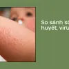 Trải nghiệm vượt qua sốt xuất huyết và dấu hiệu nguy kịch