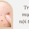 Trị mụn nội tiết dứt điểm hiệu quả chỉ sau 30 ngày