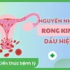 Bệnh Rong Kinh: Nguyên nhân, Dấu hiệu và Cách Điều trị Hiệu quả