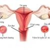 Cổ tử cung cao hay thấp: Cách nhận biết và ảnh hưởng đến khả năng mang thai