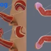 Dương vật bị cong có quan hệ được không? Ảnh hưởng và cách xử lý