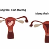 Thai ngoài tử cung: Nhận biết sớm các dấu hiệu mang thai ngoài tử cung