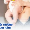 Vết mổ sau sinh bao lâu thì lành? Các yếu tố ảnh hưởng và cách chăm sóc