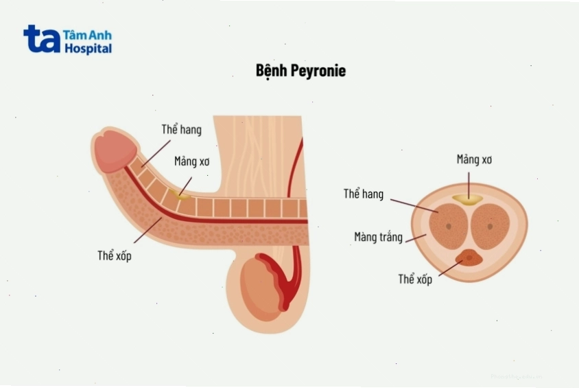 Bệnh Peyronie hình thành các mảng mô sẹo bám dọc theo dương vật