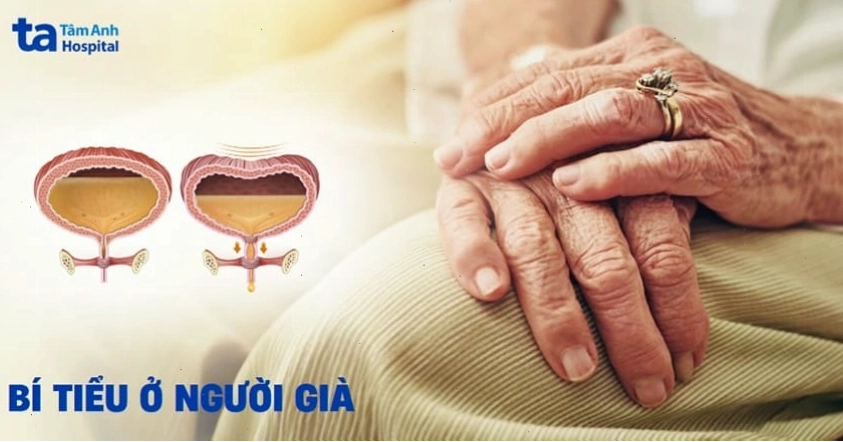 Bí tiểu ở người già cần được quan tâm đặc biệt