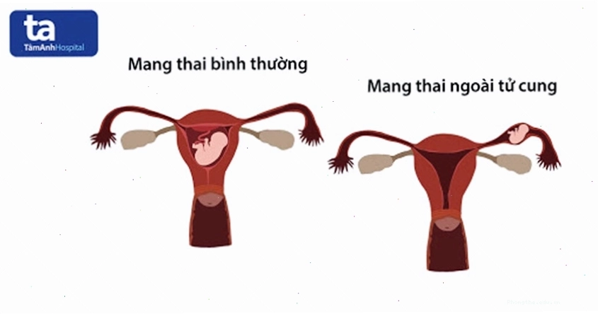 Biểu đồ các dấu hiệu nhận biết sớm thai kỳ