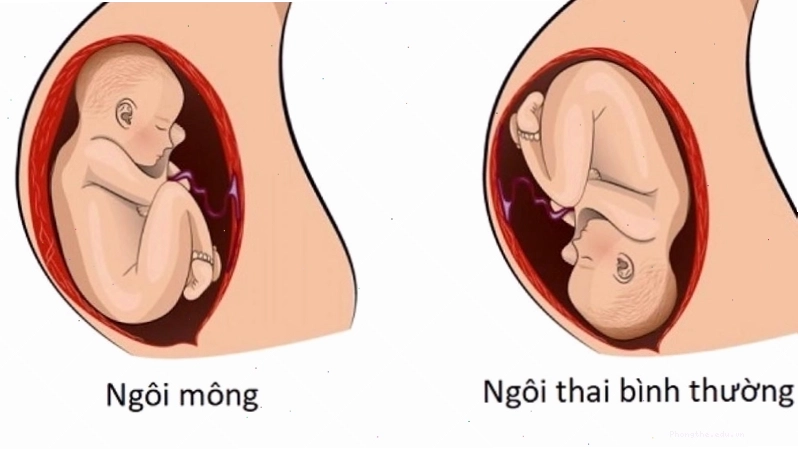 Bụng bầu có dấu hiệu tròn và nhô cao hơn khi thai nhi quay đầu
