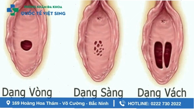 Các dạng hình dáng phổ biến của màng trinh ở nữ giới