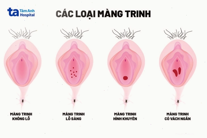 Các hình dạng khác nhau của màng trinh