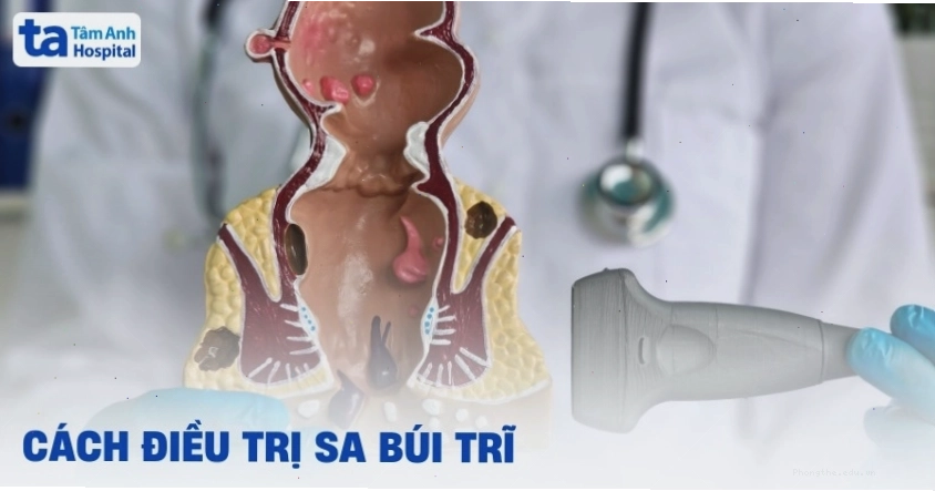 Các phương pháp điều trị sa búi trĩ hiệu quả