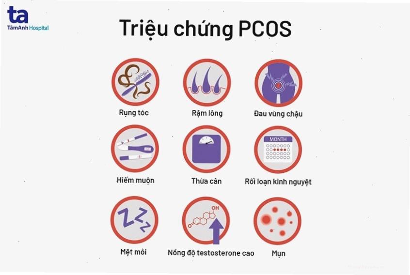 Các triệu chứng điển hình của hội chứng buồng trứng đa nang