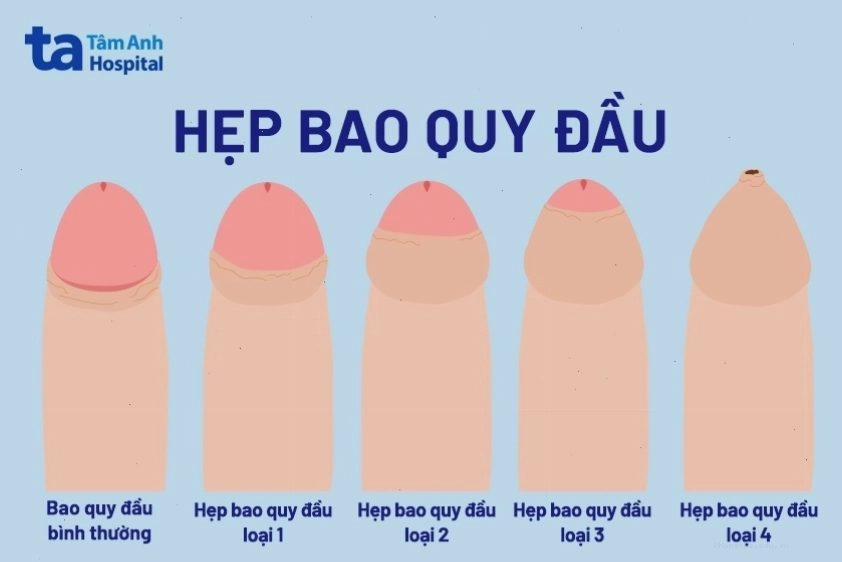 Các trường hợp nên cắt bao quy đầu