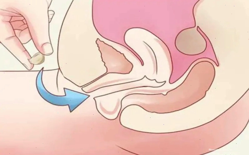 Cách đặt thuốc sau chuyển phôi là điều nhiều chị em quan tâm tìm hiểu