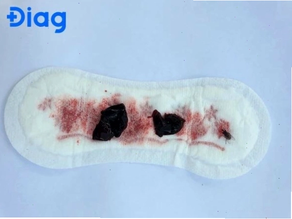 Cục máu đông kinh nguyệt lớn hơn 2.5cm cần khám bác sĩ
