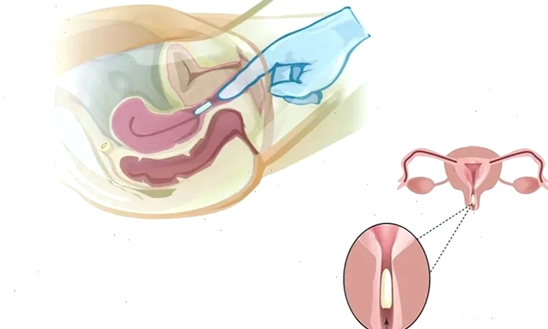 Đặt thuốc âm đạo vừa quan hệ xong: có được hay không? Cần tham khảo ý kiến chuyên gia.
