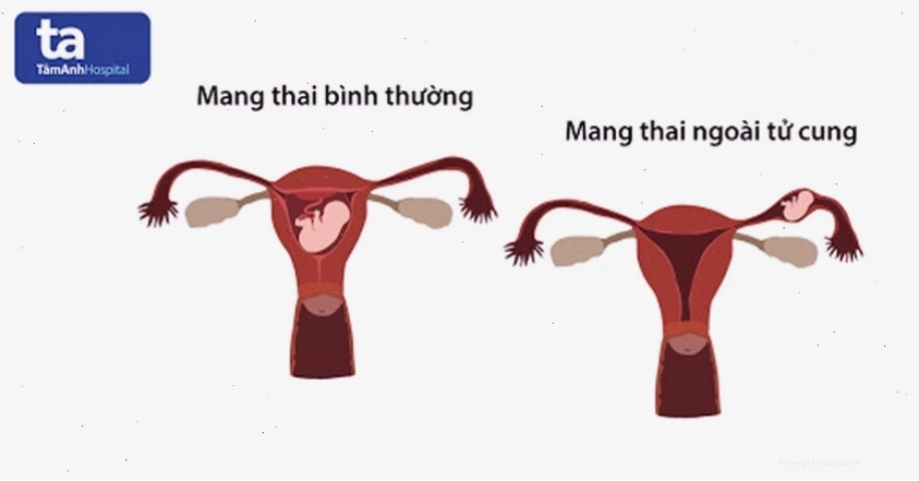Dấu hiệu mang thai ngoài tử cung