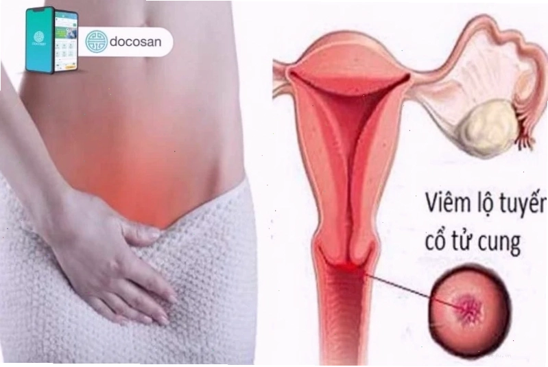 Điều trị huyết trắng vón cục theo chỉ định bác sĩ