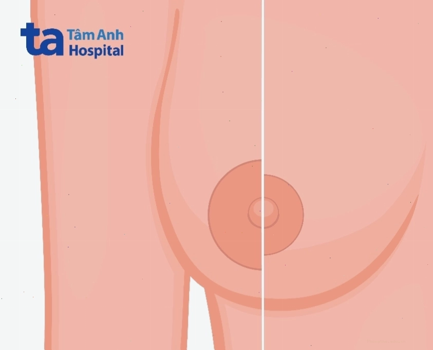 Định nghĩa quầng vú là gì và đặc điểm nhận biết