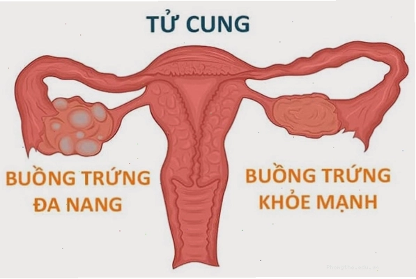 Hiện tượng u nang buồng trứng