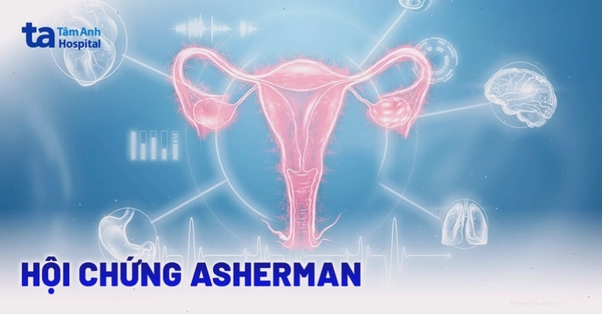 Hình ảnh minh họa hội chứng Asherman