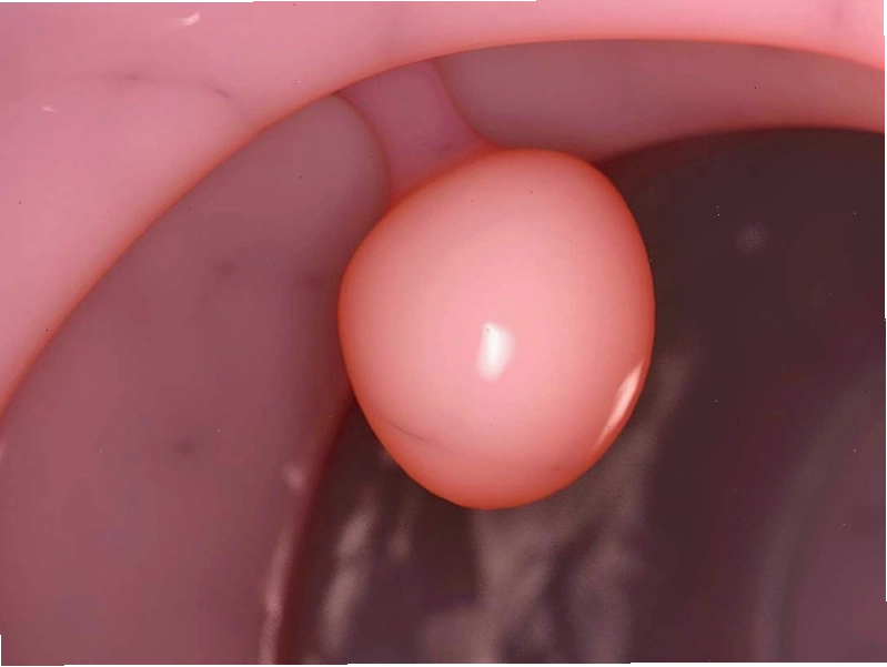 Hình ảnh minh họa polyp tử cung