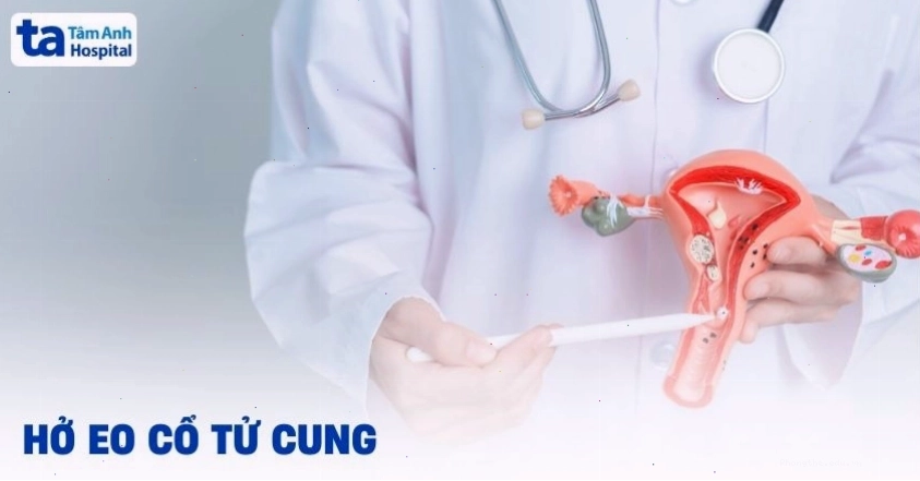 Hình ảnh minh họa tình trạng hở eo tử cung