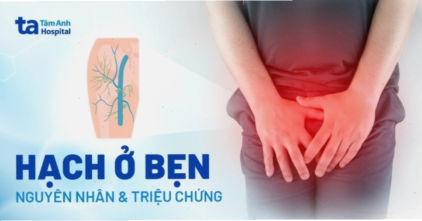 Hình ảnh minh họa tình trạng nổi hạch ở bẹn nam giới