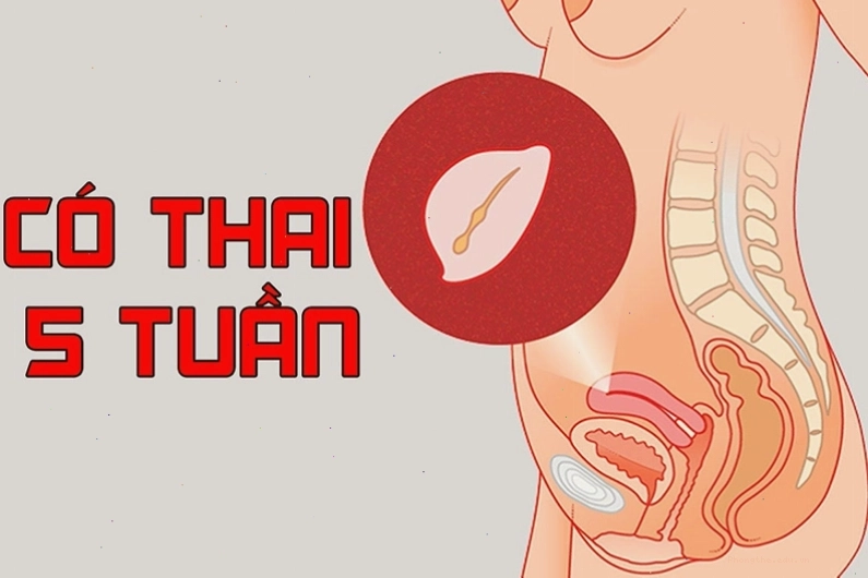 Hình ảnh siêu âm túi noãn hoàng (Yolksac) sớm trong thai kỳ