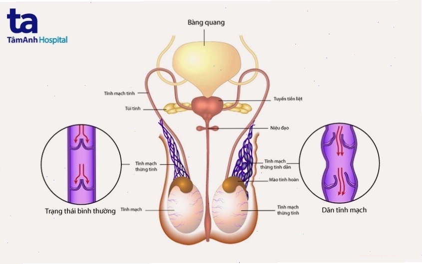 Hình ảnh tổng quan về bệnh giãn tĩnh mạch thừng tinh ở nam giới