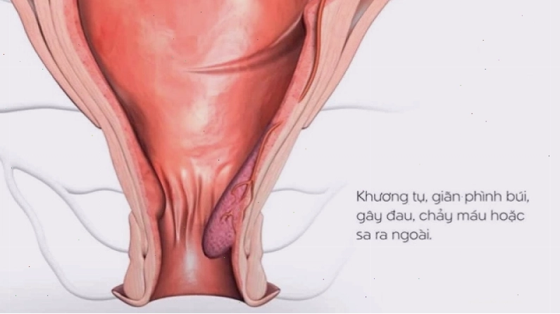 Hoa mào gà đỏ có thể trị trĩ ra máu rất tốt